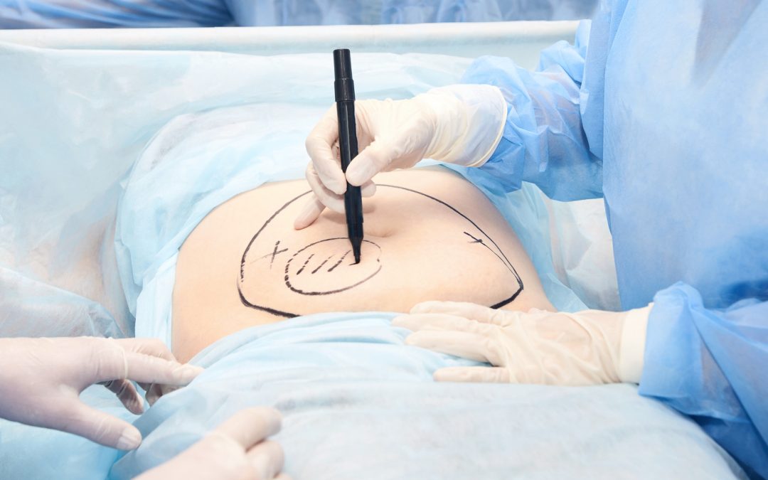 Liposuction