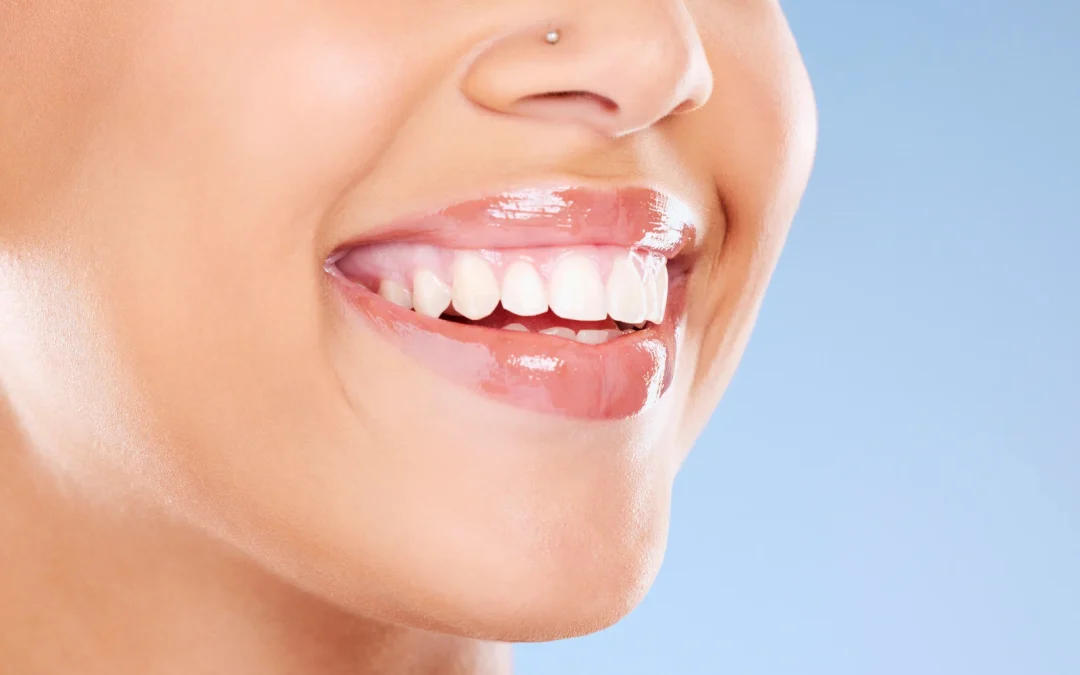 Veneer