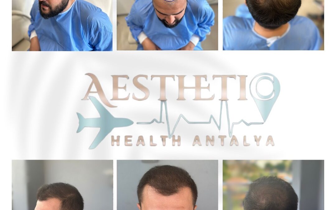 Haartransplantation Türkei – Methoden, Ablauf (2026)