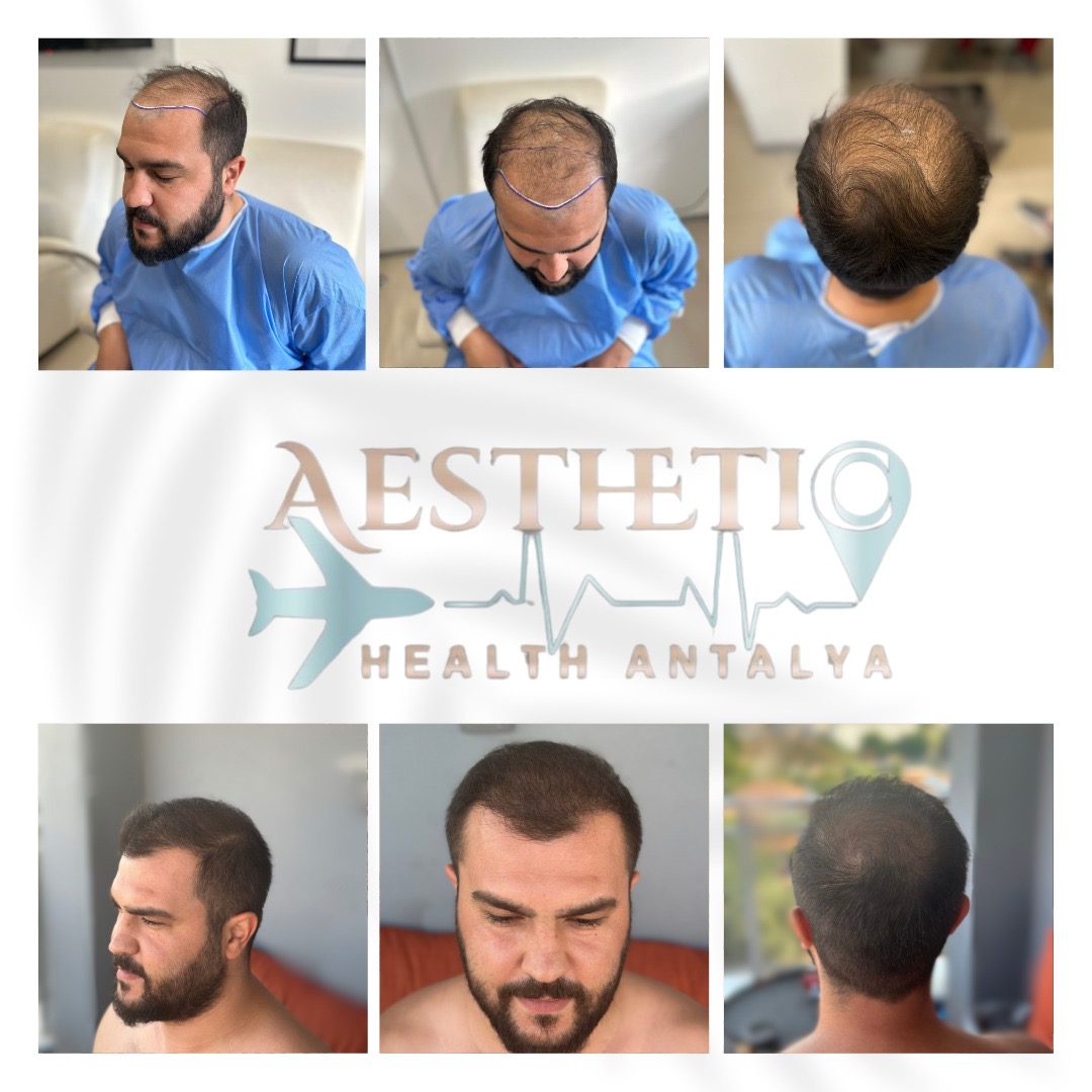 Ergebnis einer Haartransplantation Türkei vorher nachher Ergebnis einer Haartransplantation Türkei vorher nachher