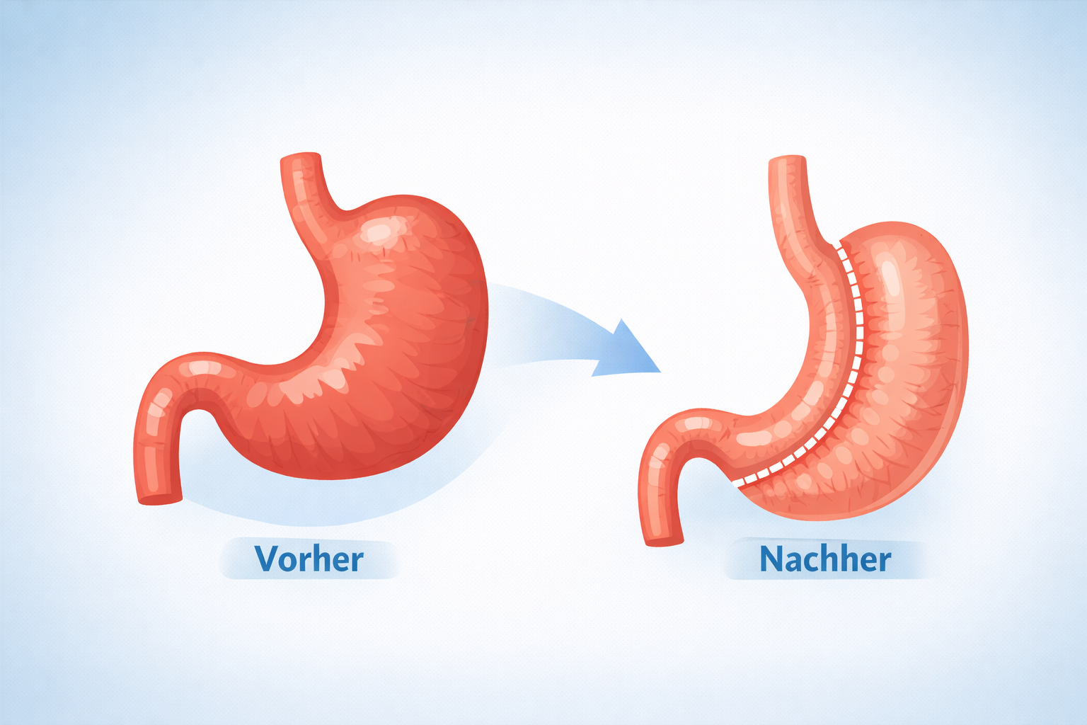 2.Magenverkleinerung (Schlauchmagen)